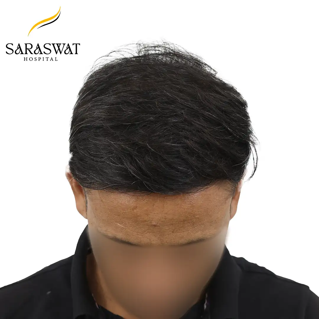 Top FUE Hair Transplant Result After Procedure
