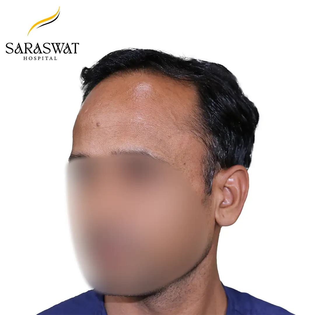 45 Degree Left FUE Hair Transplant Result Before Procedure