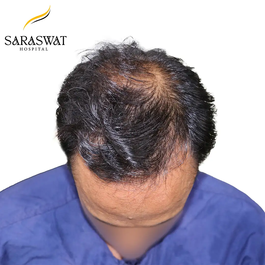 Top FUE Hair Transplant Result Before Procedure
