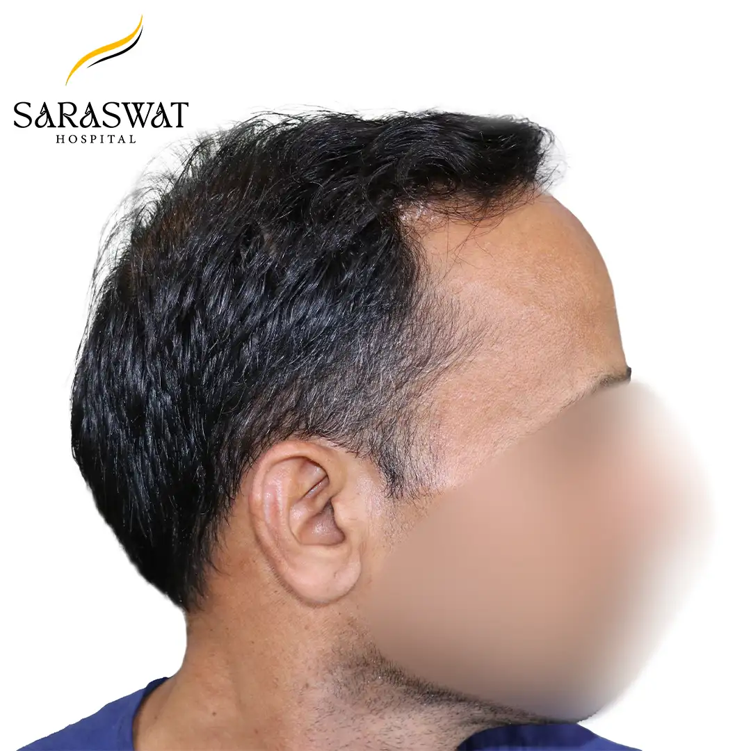 90 Degree Right FUE Hair Transplant Result Before Procedure