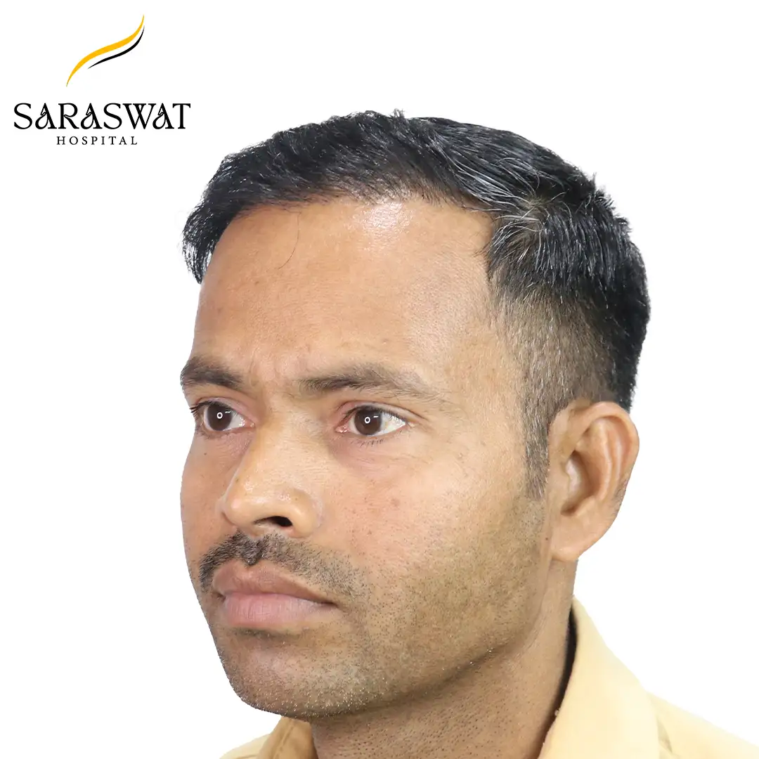 45 Degree Left FUE Hair Transplant Result After Procedure