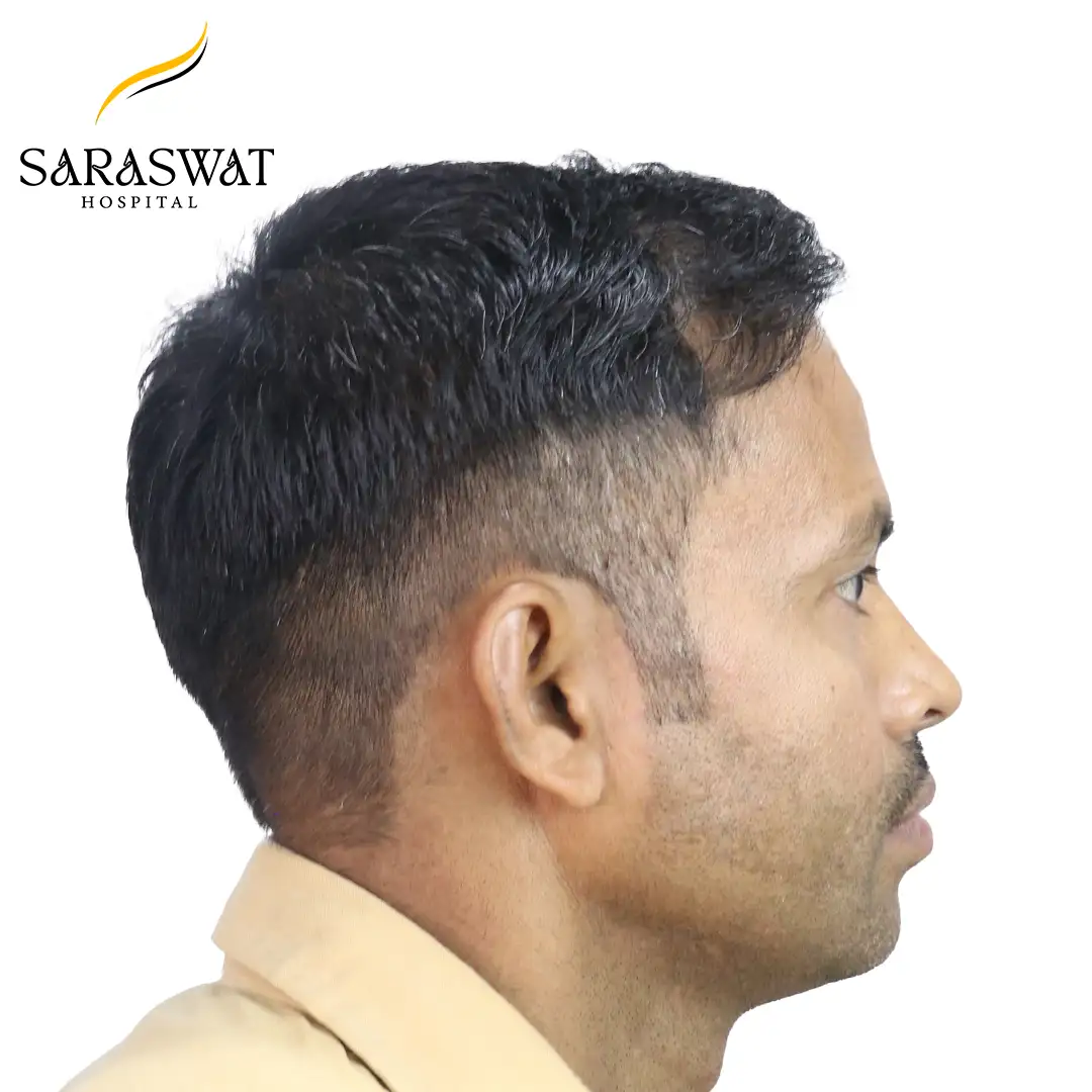 90 Degree Right FUE Hair Transplant Result After Procedure