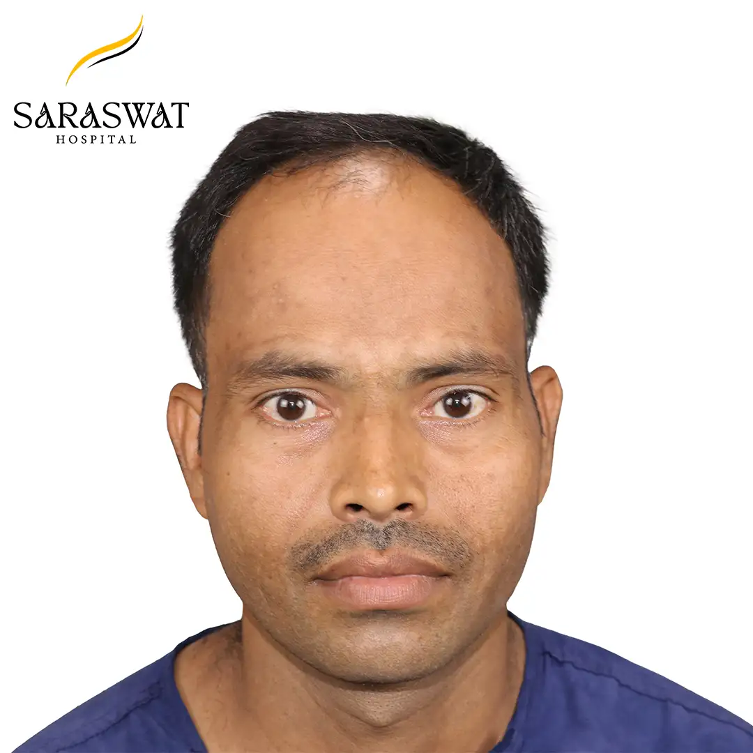 Front FUE Hair Transplant Result Before Procedure