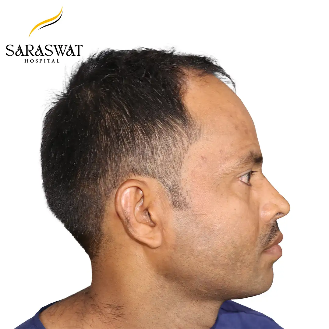 90 Degree Right FUE Hair Transplant Result Before Procedure