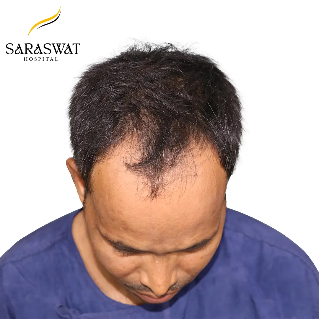Top FUE Hair Transplant Result Before Procedure