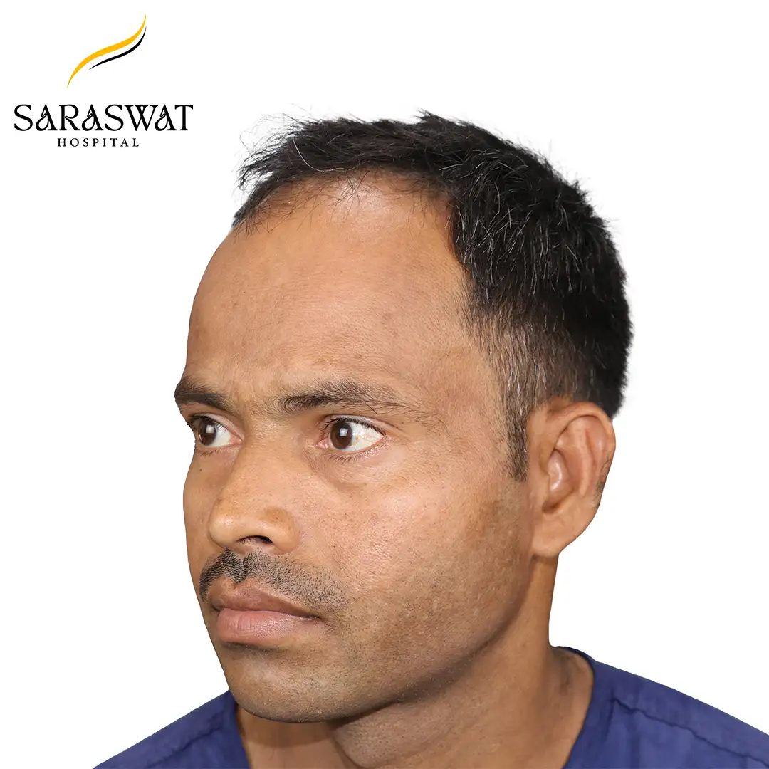 45 Degree Left FUE Hair Transplant Result Before Procedure
