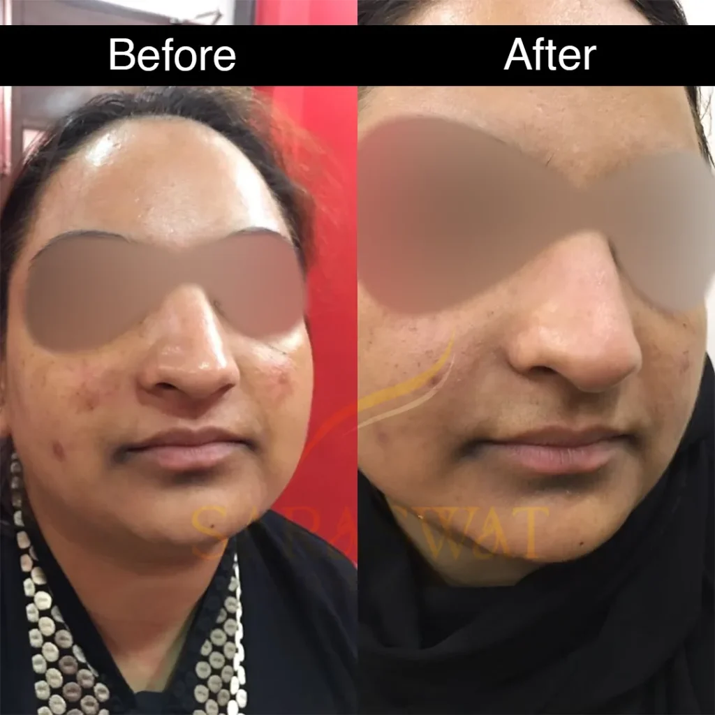carbon laser peel before and after