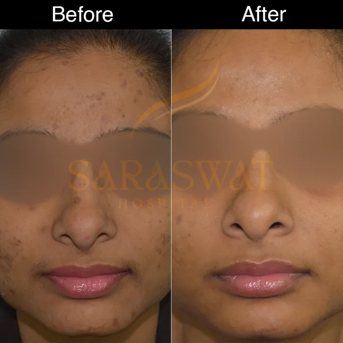 chemical peels before after