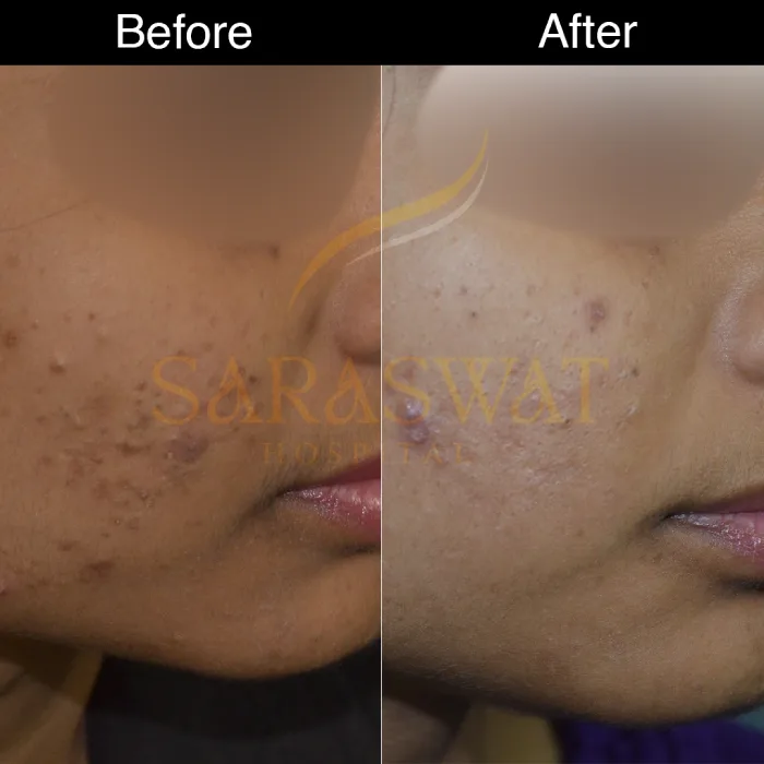 chemical peels before after