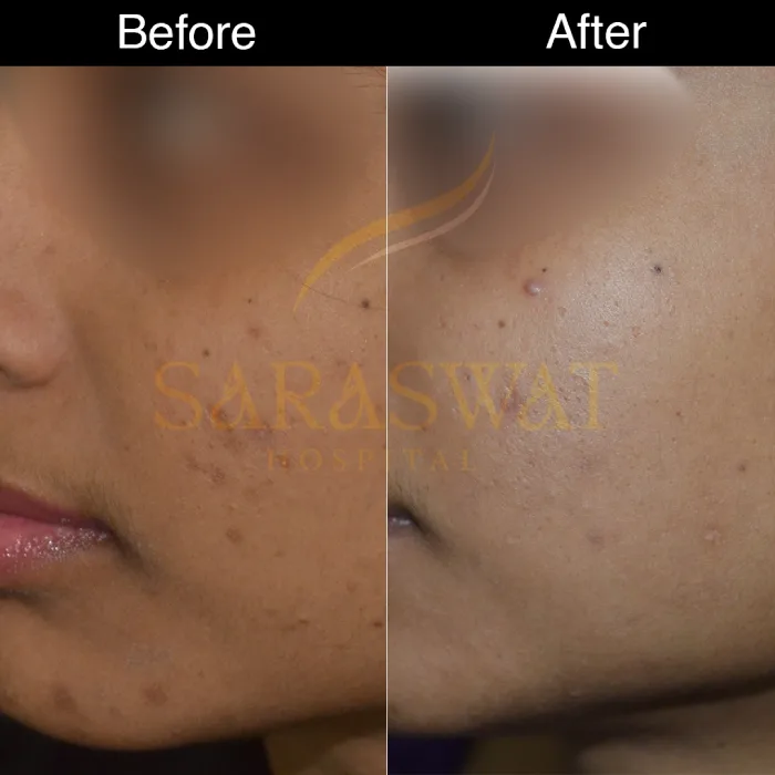 chemical peels before after