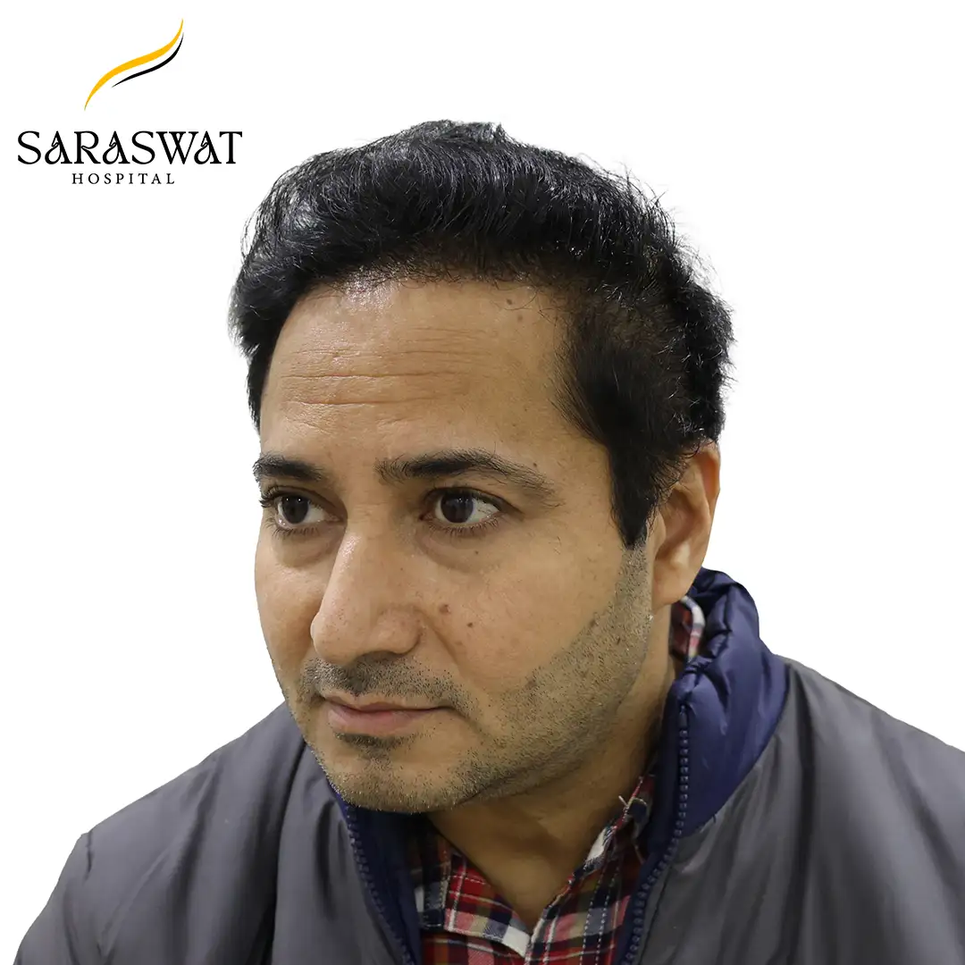 Hair Transplant Before and After