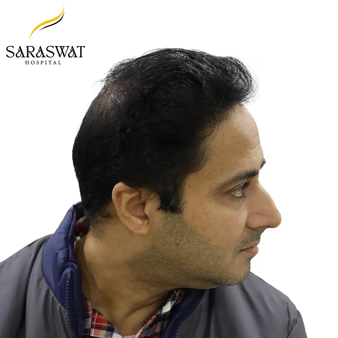 Hair Transplant Before and After