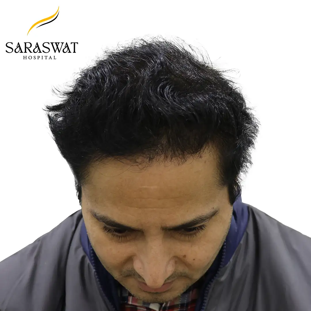 Hair Transplant Before and After