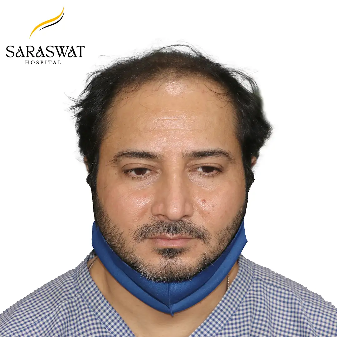 Hair Transplant Before and After