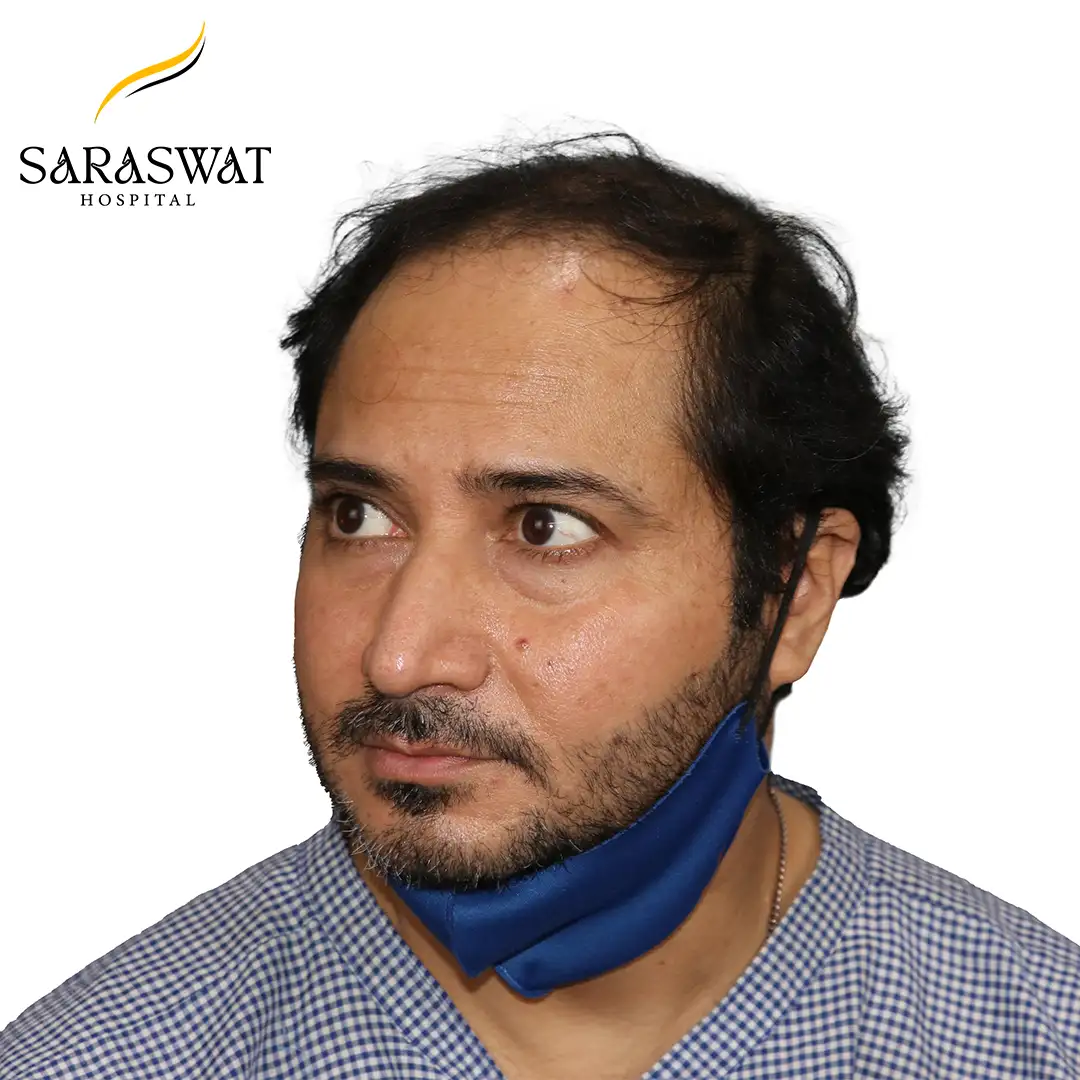 Hair Transplant Before and After