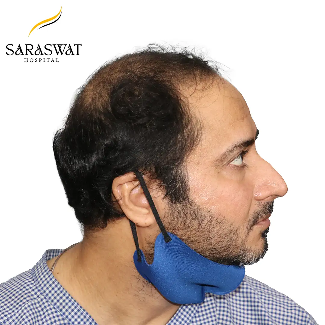 Hair Transplant Before and After