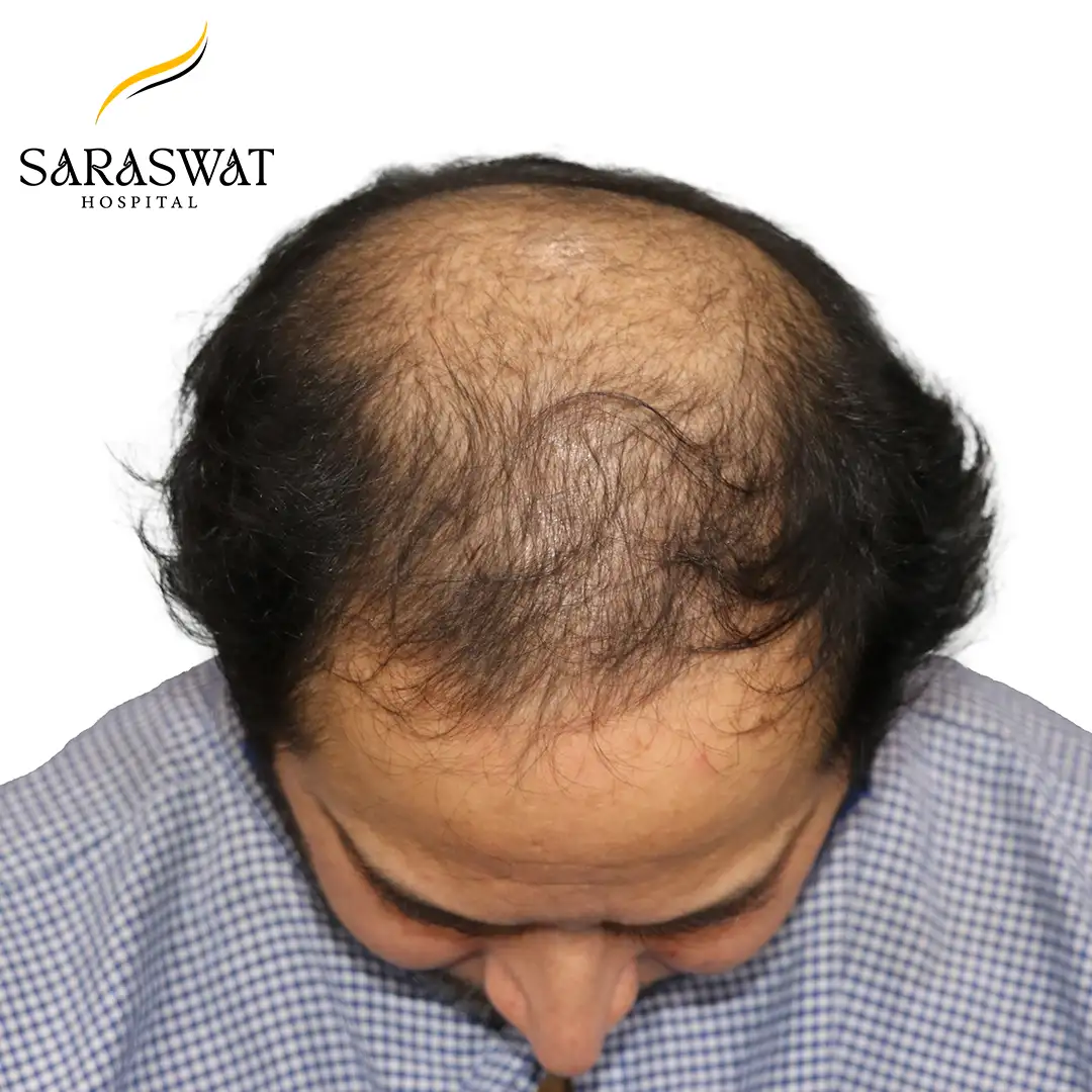 Hair Transplant Before and After