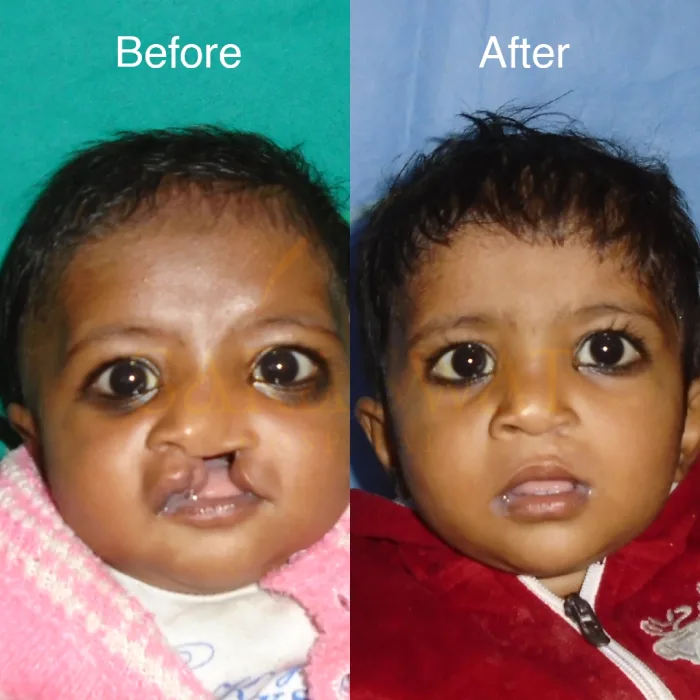 Cleft Lip & Cleft Palate Surgery in India