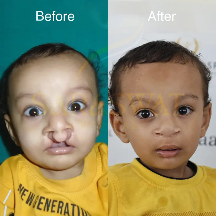 Cleft Lip and Palate Result