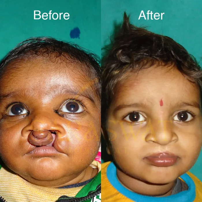 Cleft Lip and Palate Result