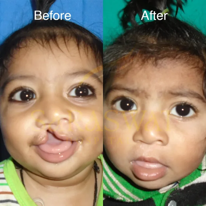 Cleft Lip Result