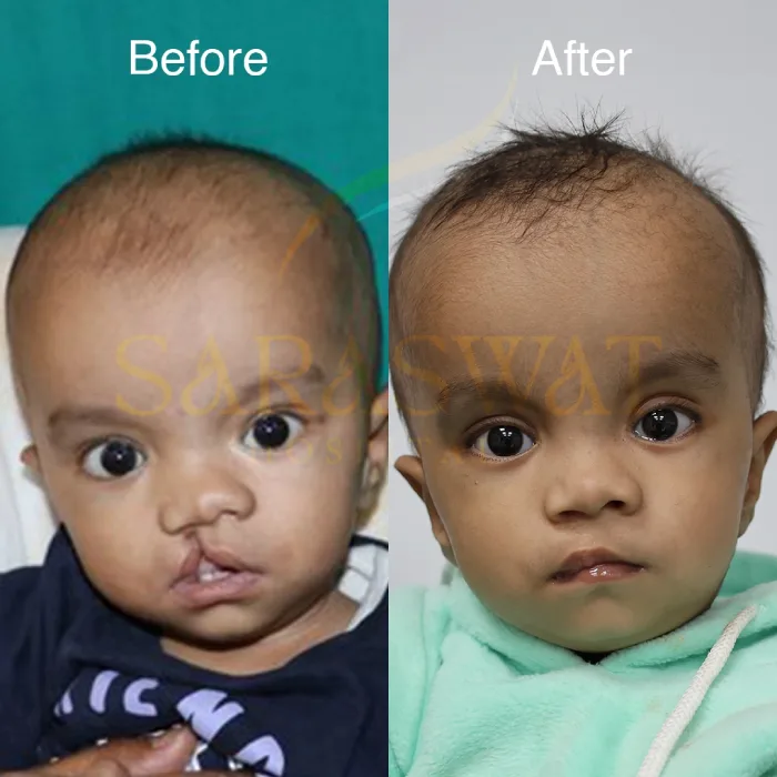 Cleft Lip and Palate Result