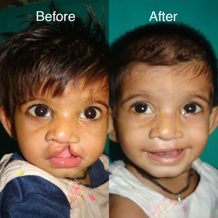 Cleft Lip Result