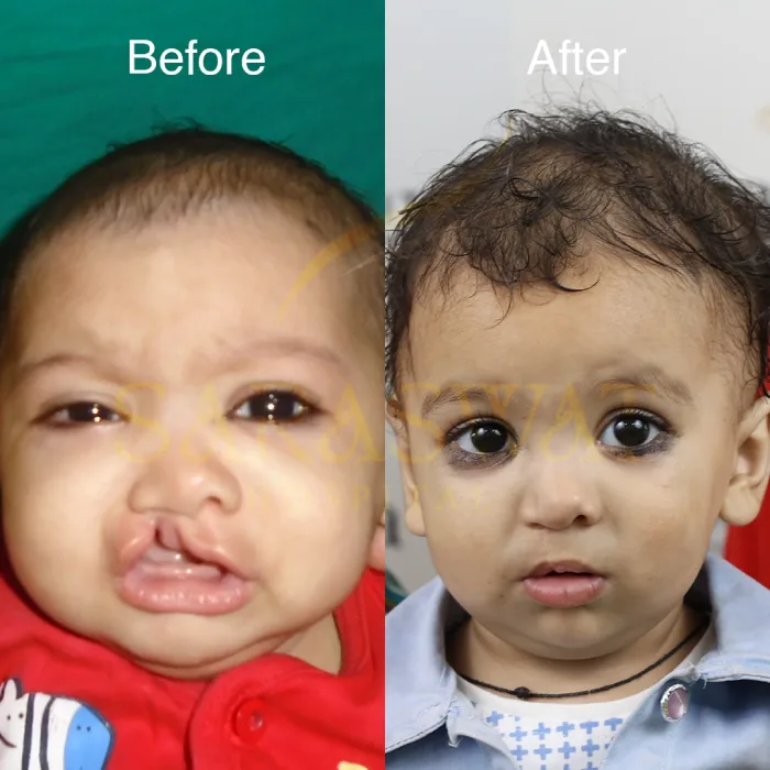 Cleft Lip Result
