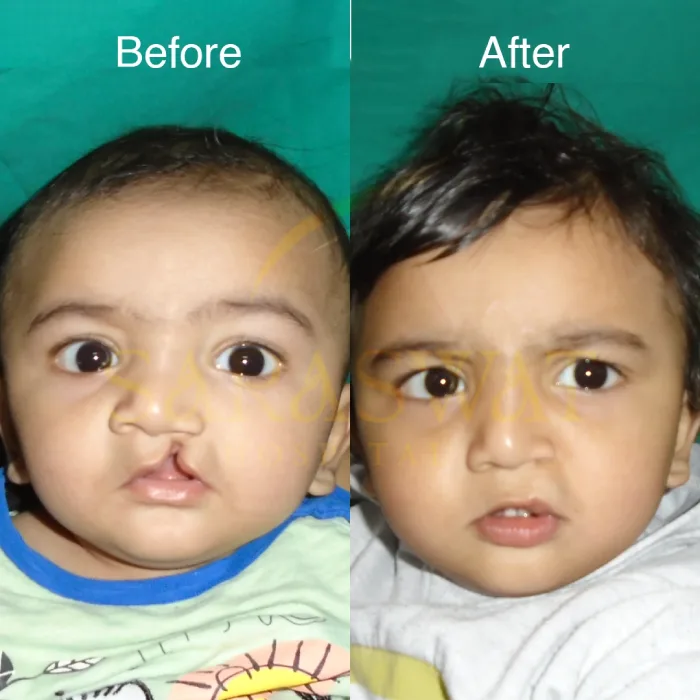 Best Hospital for Cleft Lip and Palate