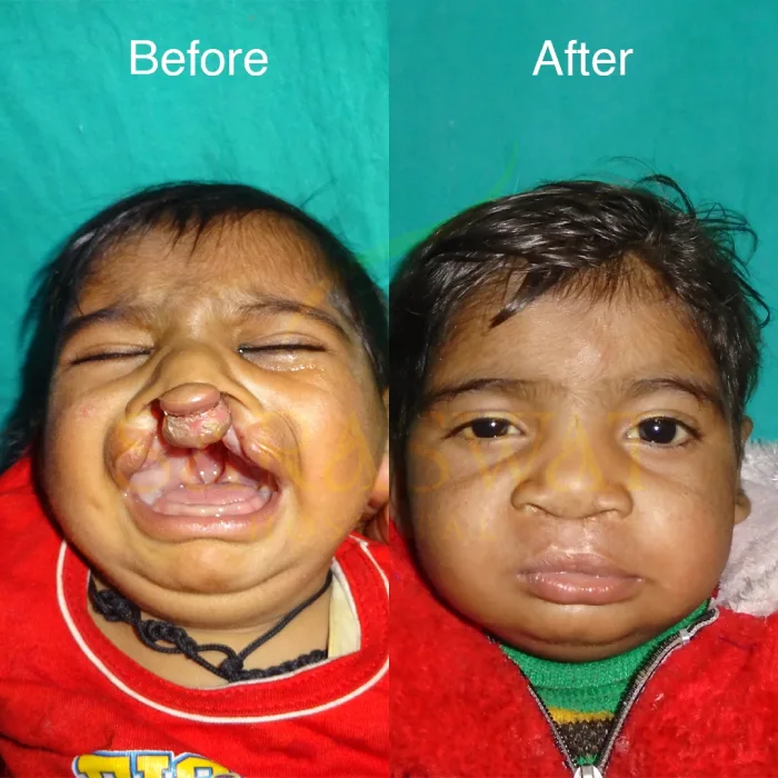 Cleft Lip Result