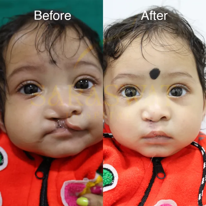 Cleft Lip & Palate Surgery in India