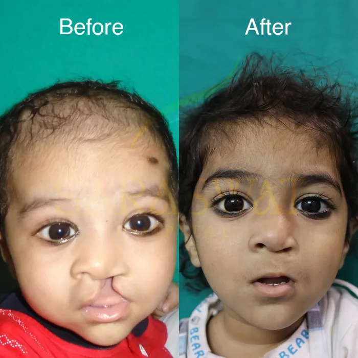 Cleft Lip & Cleft Palate Surgery in India
