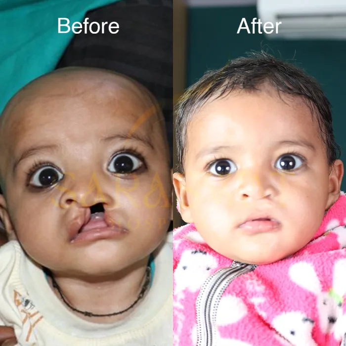 Cleft Lip and Palate Result