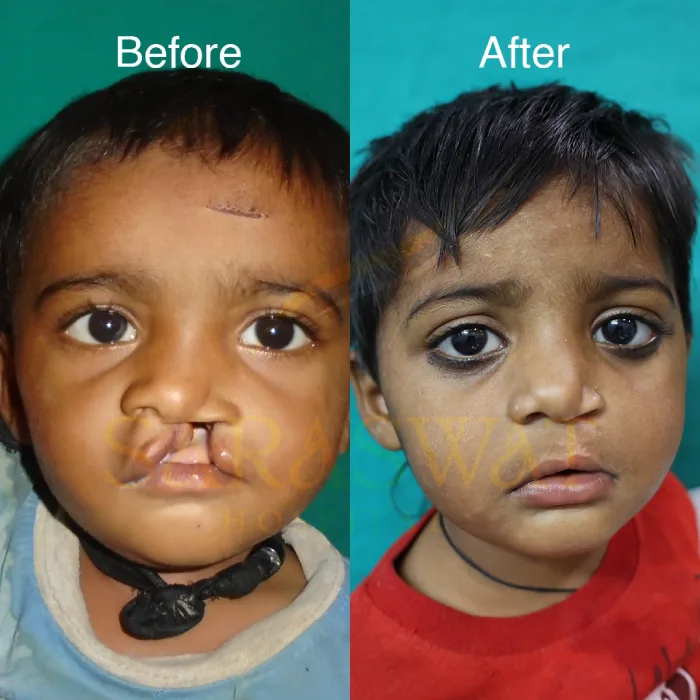 Cleft Lip & Cleft Palate Surgery in India