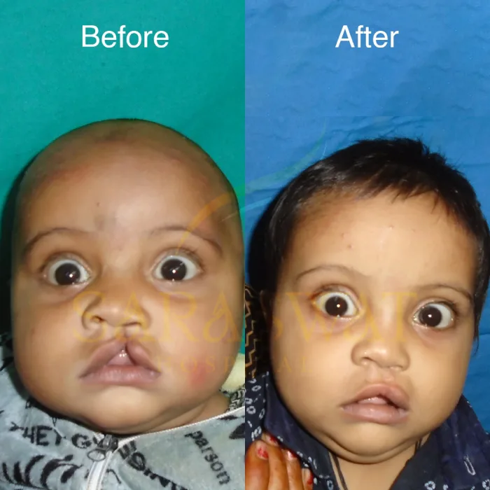 Cleft Lip & Cleft Palate Surgery in India