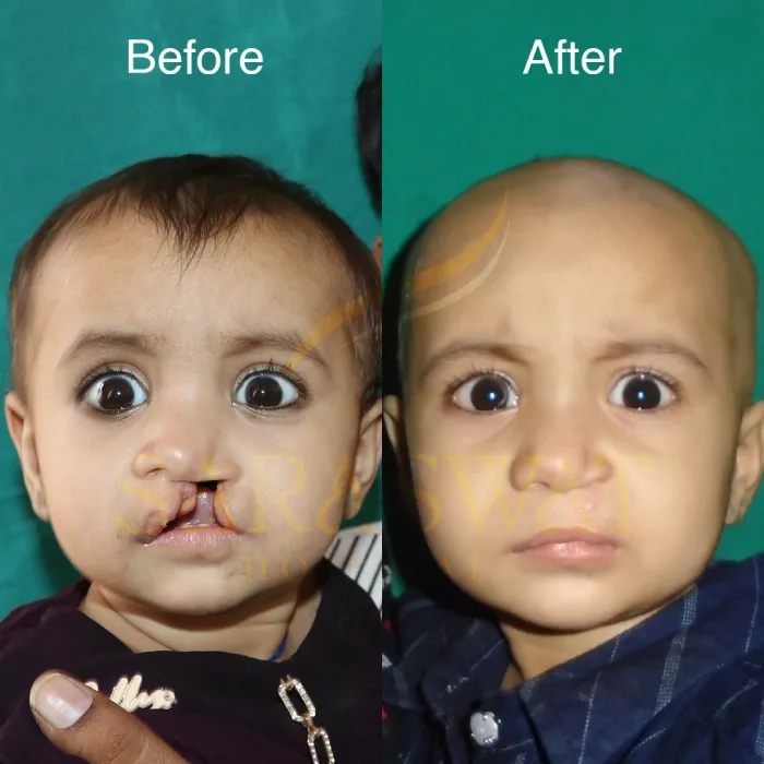 Cleft Lip & Palate Surgery in India