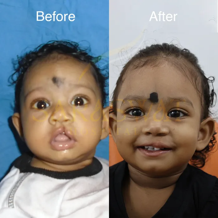 Cleft Lip & Palate Surgery in India