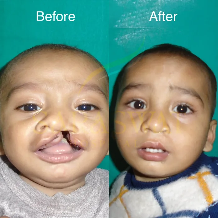 Cleft Lip and Palate Hospital in Agra