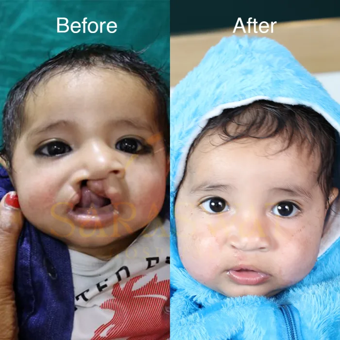 Cleft Lip and Palate Hospital in Agra