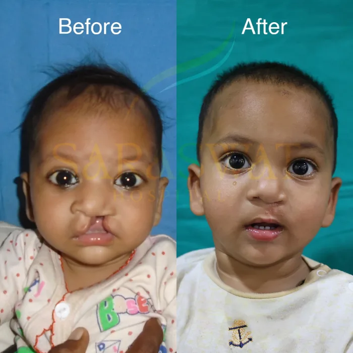 Cleft Lip and Palate Result