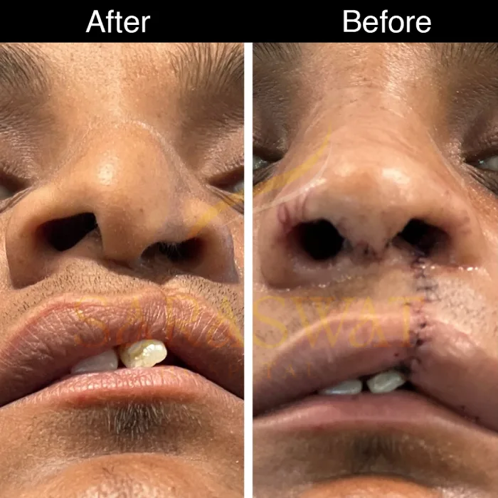 Cleft Rhinoplasty Before and After