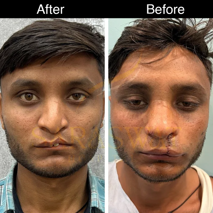 Cleft Rhinoplasty Before and After