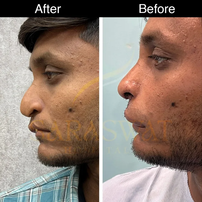 Cleft Rhinoplasty Before and After