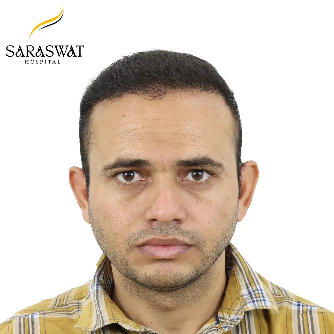 Front FUE Hair Transplant Result After Procedure