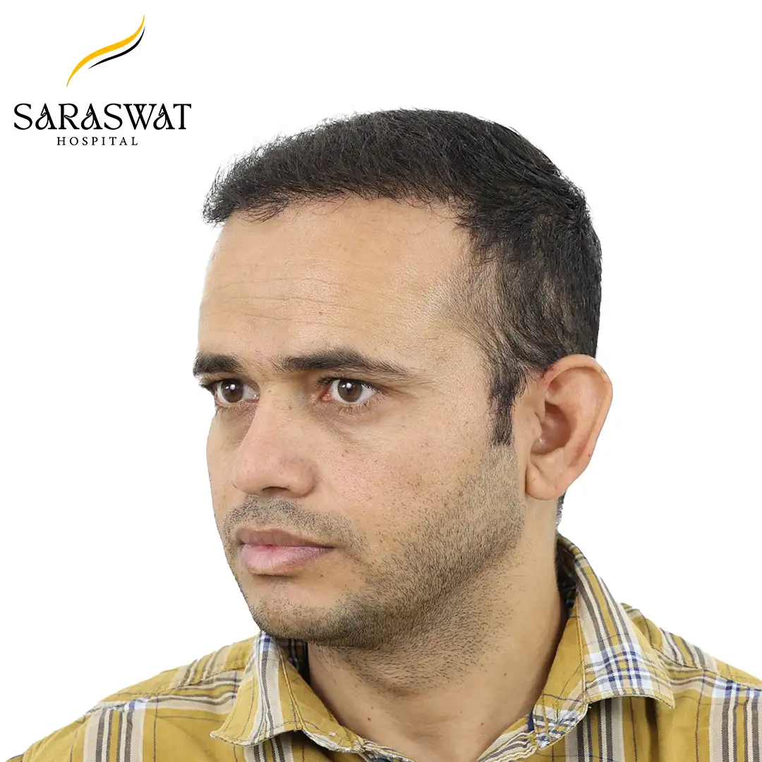 45 Degree Left FUE Hair Transplant Result After Procedure