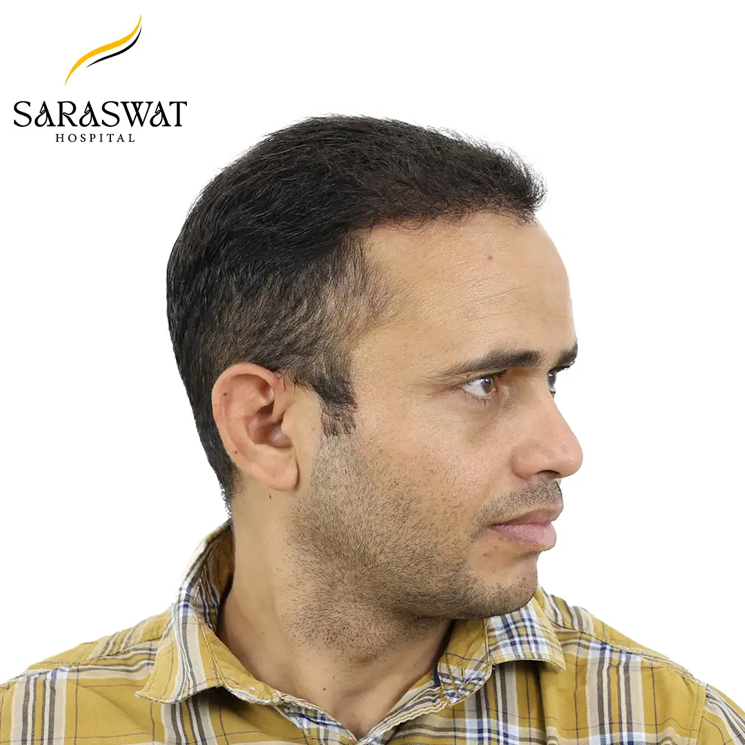 90 Degree Right FUE Hair Transplant Result After Procedure