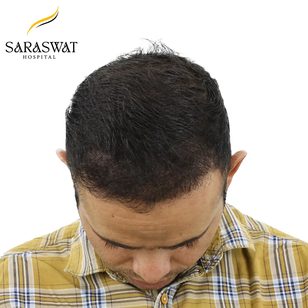 Top FUE Hair Transplant Result After Procedure