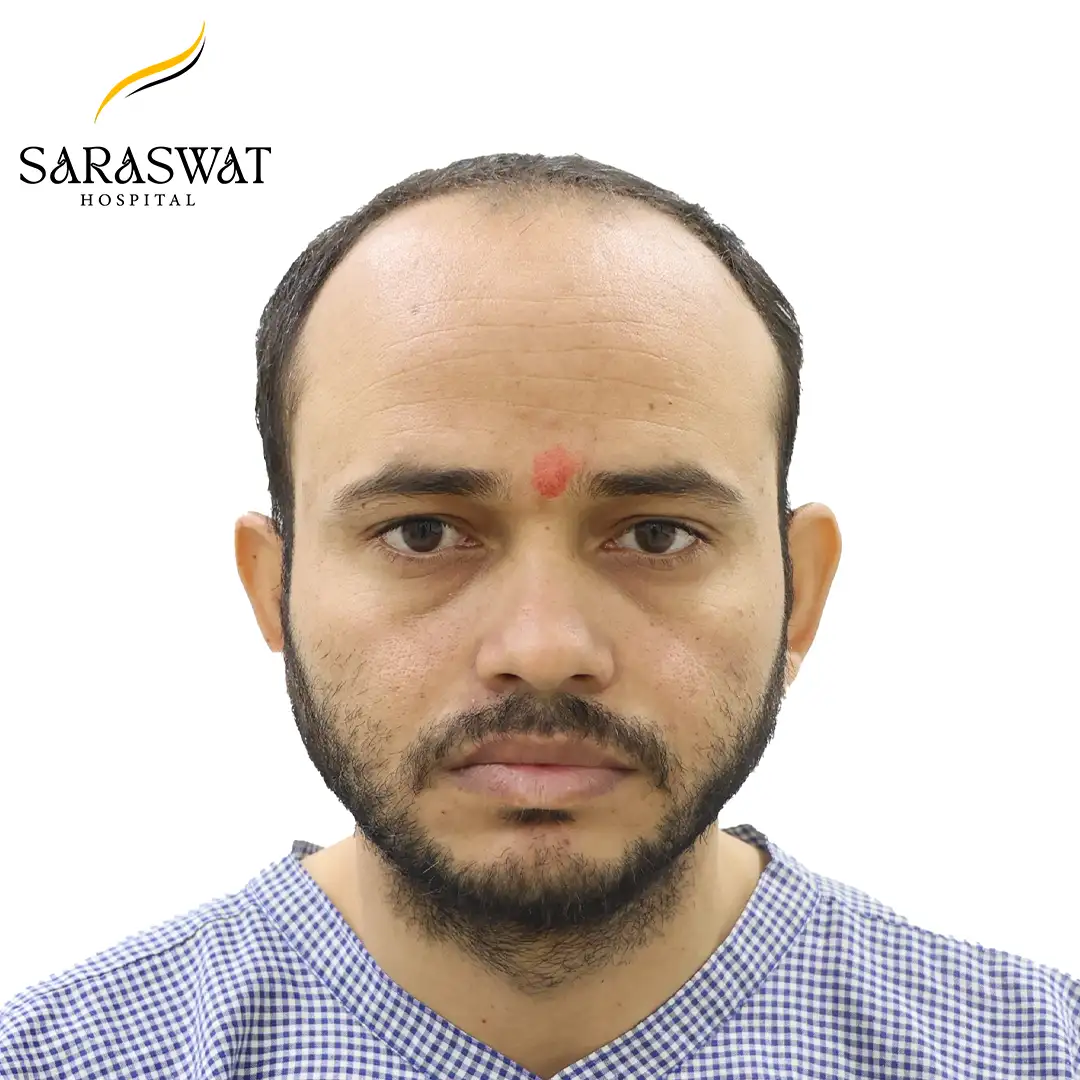 Front FUE Hair Transplant Result Before Procedure