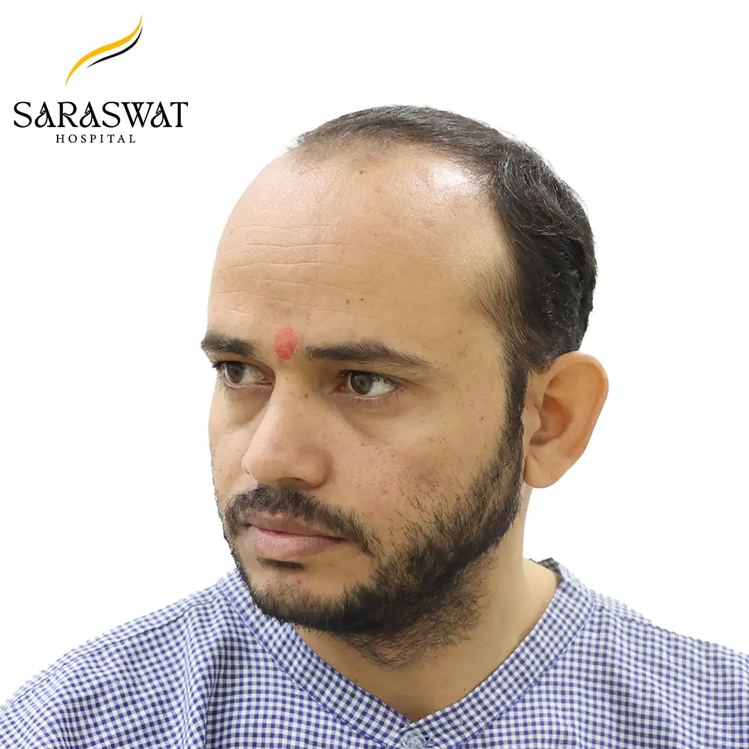 45 Degree Left FUE Hair Transplant Result Before Procedure