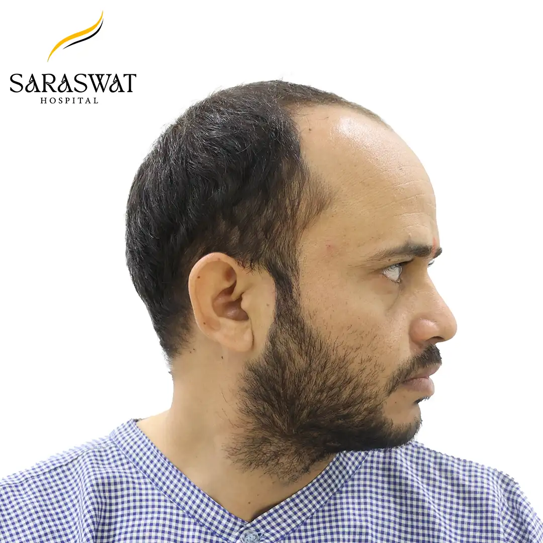 90 Degree Right FUE Hair Transplant Result Before Procedure